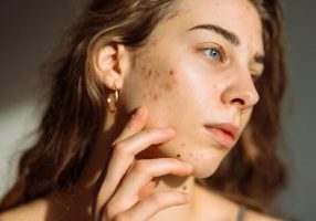 woman hormonal acne