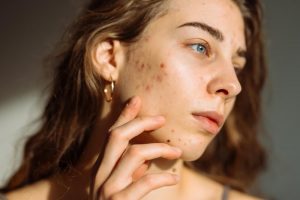 woman hormonal acne