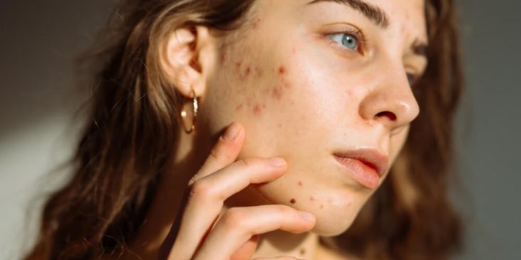 woman hormonal acne